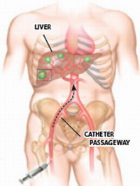 Рак печени - катетеризация печеночной артерии